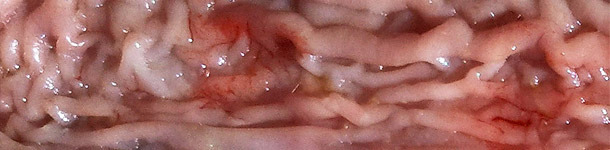 Epaissisement de la muqeuse en partie distale de l'intestin gr&ecirc;le