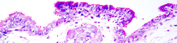N&eacute;crose coagulante sur les trophoblastes  Coloration h&eacute;matoxyline-&eacute;osine