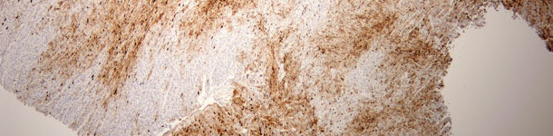 L&eacute;sion myocardique s&eacute;v&egrave;re due au PCV2