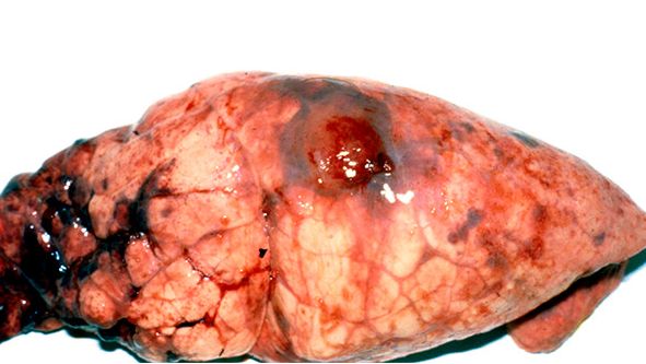 L&eacute;sions d&rsquo;App chronique sur le lobe diaphragmatique avec des d&eacute;p&ocirc;ts de fibrine.
