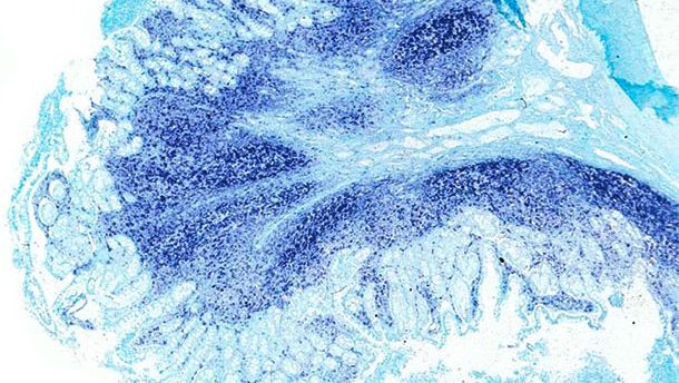 Il&eacute;on. Le m&ecirc;me il&eacute;on du porc atteint par la maladie syst&eacute;mique associ&eacute;e au PCV2 pr&eacute;sente une grande quantit&eacute; de g&eacute;nome de PCV2 sur les plaques de Peyer et dans la muqueuse intestinale. Hybridation in situ pour d&eacute;tecter le PCV2 ; colorant de contraste vert rapide