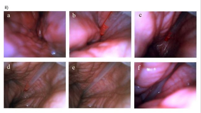 Insémination post-cervicale vue de l’intérieur de l’utérus.
