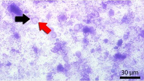 Frottis f&eacute;cal color&eacute; par Diff-Quick. La fl&egrave;che rouge signale la vacuole centrale et la noire le noyau.