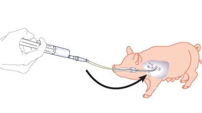 Figure 1. Schéma du lacvage boncho-alvéolaire et du curetage bronchique