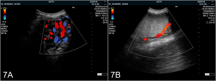 Figure 7: Images du testicule obtenues par échographie Doppler couleur A) Vaisseaux du cordon spermatique B) Artère testiculaire