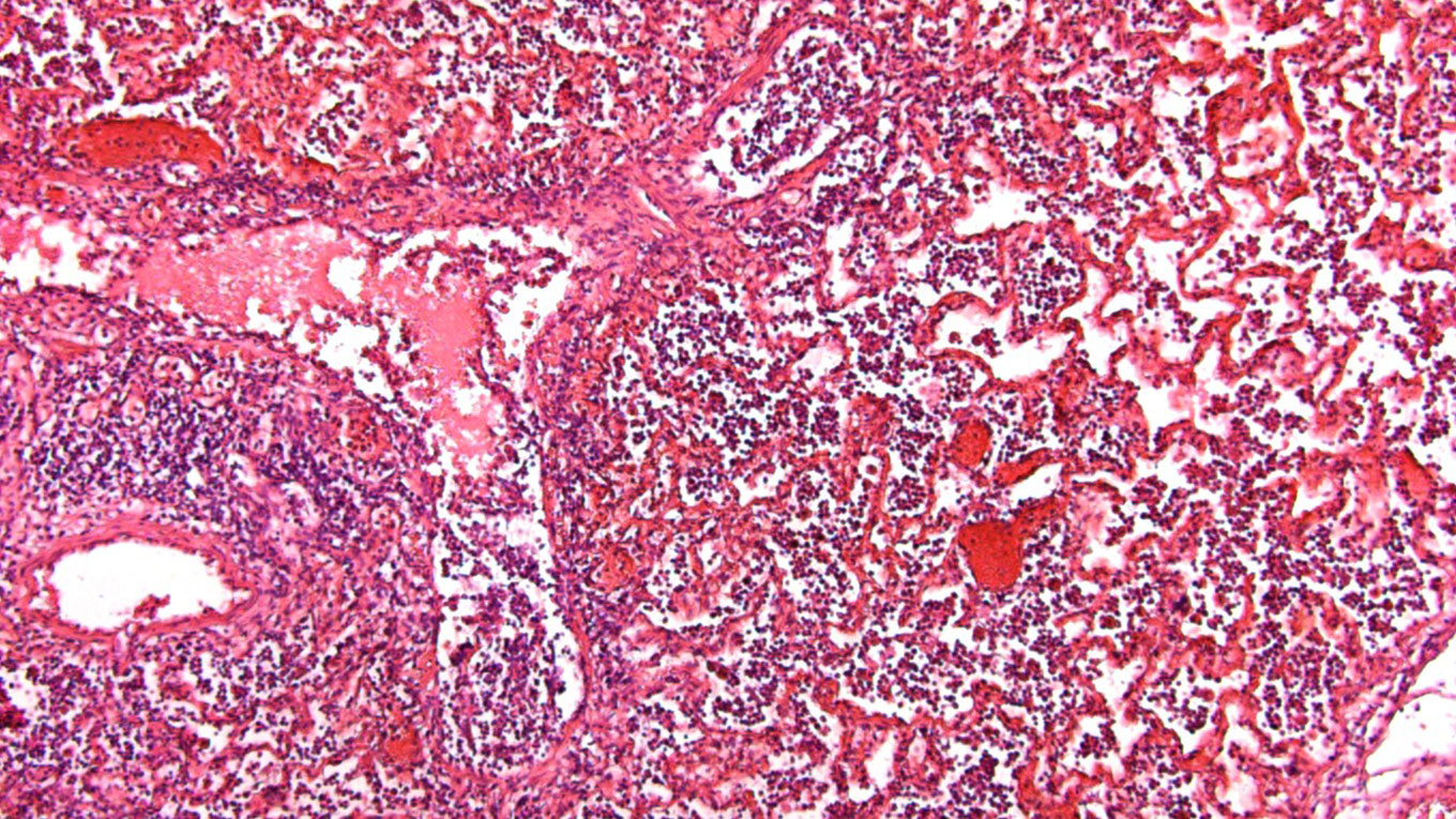 Alv&eacute;oles avec accumulation de liquide et cellules inflammatoires