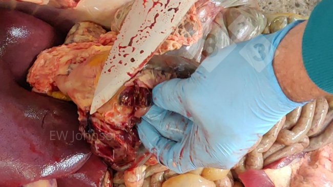 Photo 2. Hémorragie et nécrose dans un ganglion lymphatique gastro-hépatique.