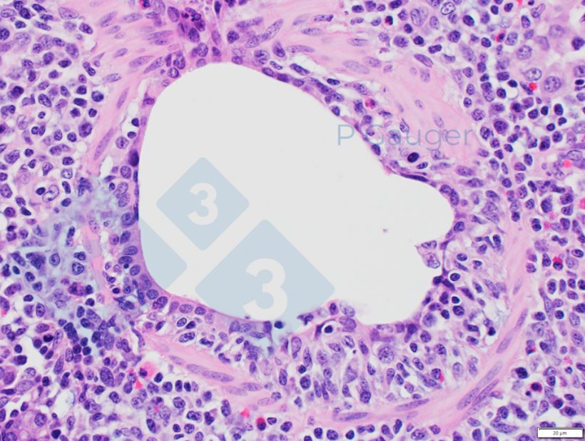 Figure 4 : Histopathologie du poumon montrant un amincissement de l&#39;&eacute;pith&eacute;lium bronchiolaire, ce qui est un exemple de n&eacute;crose (Source photo : Phil Gauger ISUVDL).
