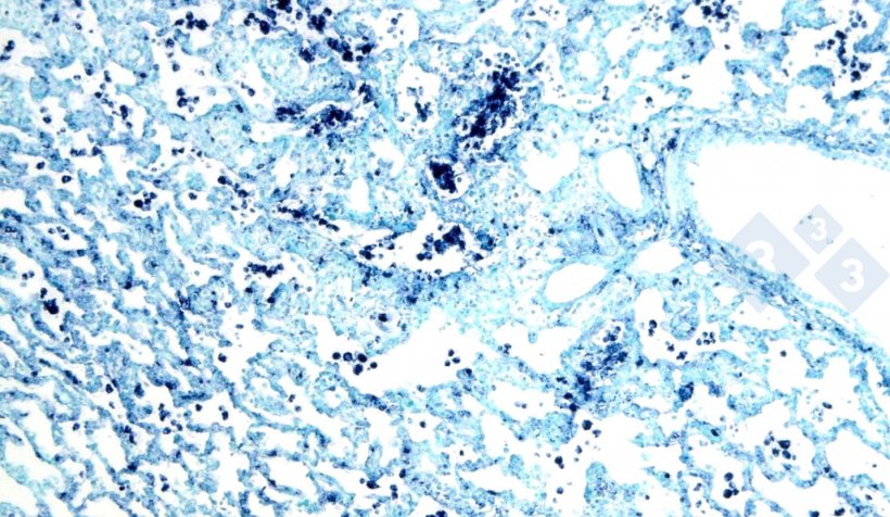 Figure 4 : Hybridation in situ pour le circovirus porcin 2 (PCV2) dans un poumon atteint de pneumonie interstitielle.
