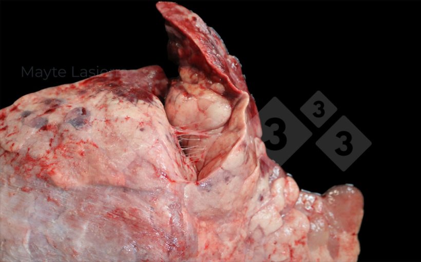 Pleur&eacute;sie cr&acirc;niale
