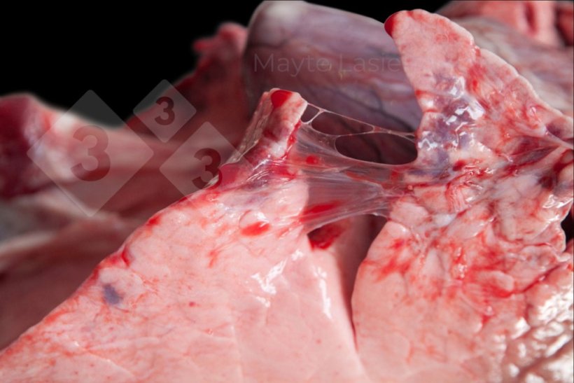 Pleur&eacute;sie cr&acirc;niale
