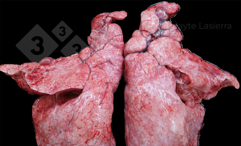 Pleur&eacute;sie cr&acirc;niale
