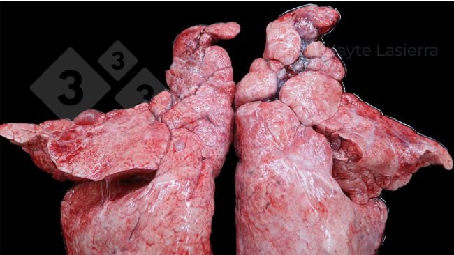 Pleurésie crâniale