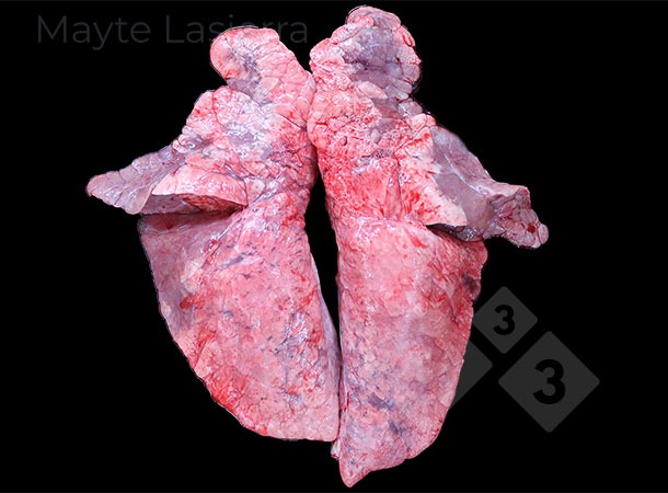 Processus de bronchopneumonie
